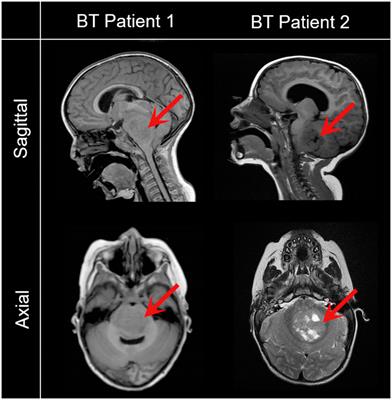 Generation of mesenchymal stromal cells from urine-derived iPSCs of pediatric brain tumor patients